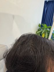 -碧莲盛·不剃发植发