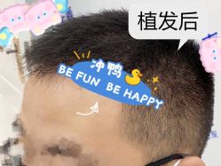 -大麦微针植发全国连锁