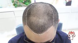 -大麦微针植发丨全国连锁