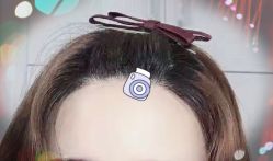 -大麦微针植发全国连锁