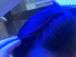 -碧莲盛·不剃发植发