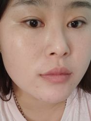 体验后-SKIN79皮肤管理中心