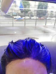 -碧莲盛·不剃发植发