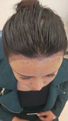 -大麦微针植发丨全国连锁