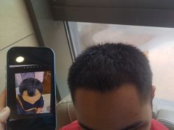 点击看大图 -碧莲盛·不剃发植发