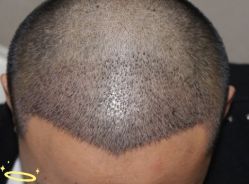 -大麦微针植发丨全国连锁