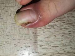 -祖传修脚甲沟炎灰指甲鸡眼