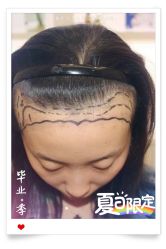 -大麦微针植发全国连锁