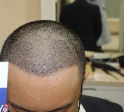 -大麦微针植发丨全国连锁