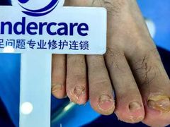 -Andrew指甲专科灰指甲·甲沟炎矫正·3D步态矫形鞋垫定制(浦三路店)
