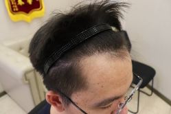 -大麦微针植发丨全国连锁