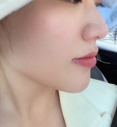 体验后-亿美医疗美容·半岛大超炮官方授权店