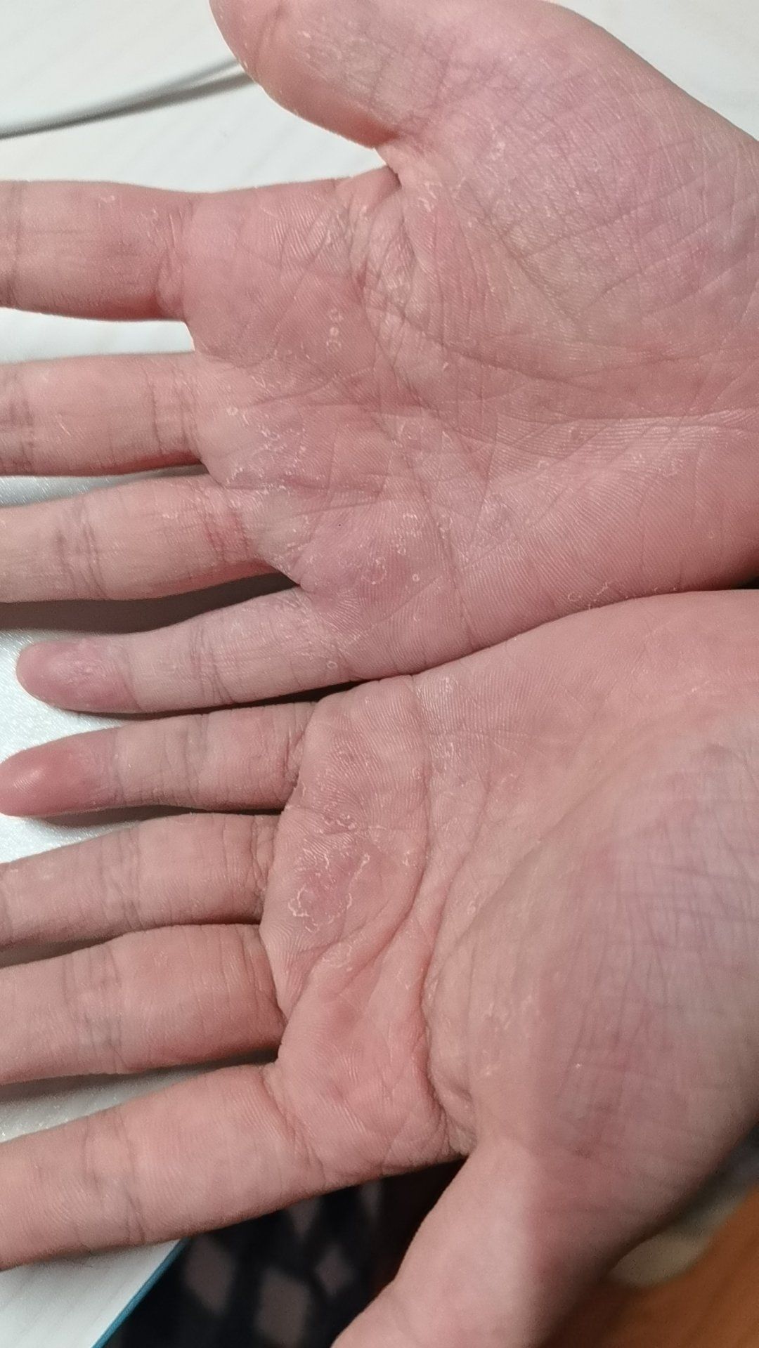 手痒掉皮,有小水泡,去医院开了药也没什么