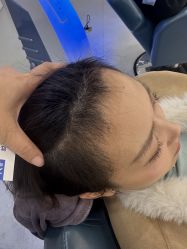 体验后-大麦微针植发全国连锁