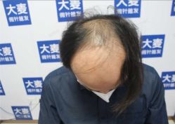 -大麦微针植发丨全国连锁