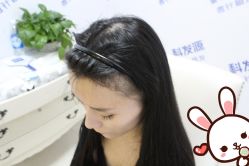 点击看大图 -大麦微针植发丨全国连锁