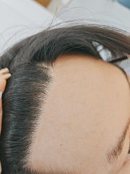 -大麦微针植发全国连锁