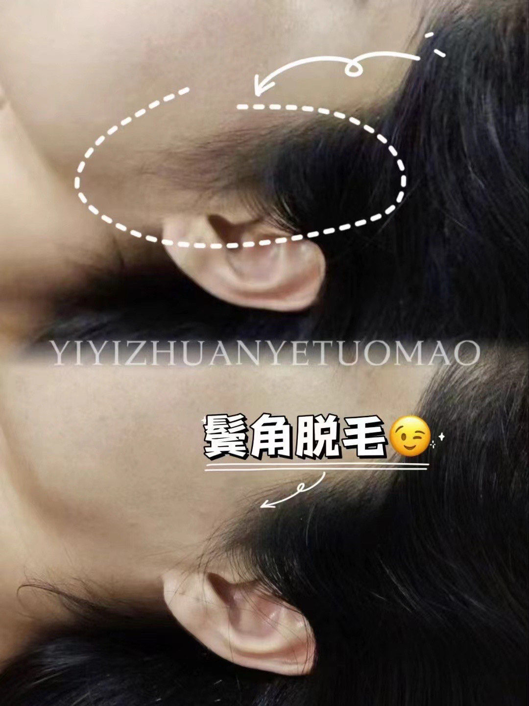 杀,
需要精心规划毛发的生长位置[玫瑰]
​#依依专业脱毛连锁店