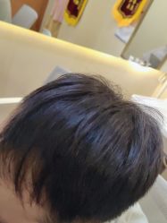 点击看大图 -碧莲盛·不剃发植发