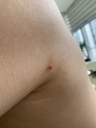 -美丽人生祛斑扁平疣汗管瘤中心