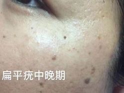-美人痣全国连锁