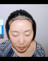 体验前-大麦微针植发全国连锁