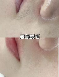 -薇兰专业脱毛连锁机构