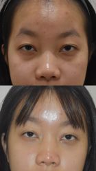 -广州健丽·去眼袋医疗美容机构