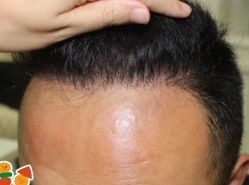 -大麦微针植发丨全国连锁