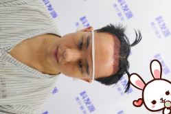 -大麦微针植发丨全国连锁