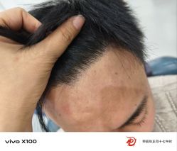 体验后-大麦微针植发全国连锁