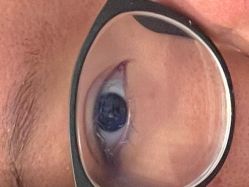 体验前-KS科逆美肤祛痘