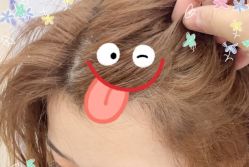 -大麦微针植发全国连锁