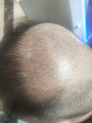 -碧莲盛·不剃发植发