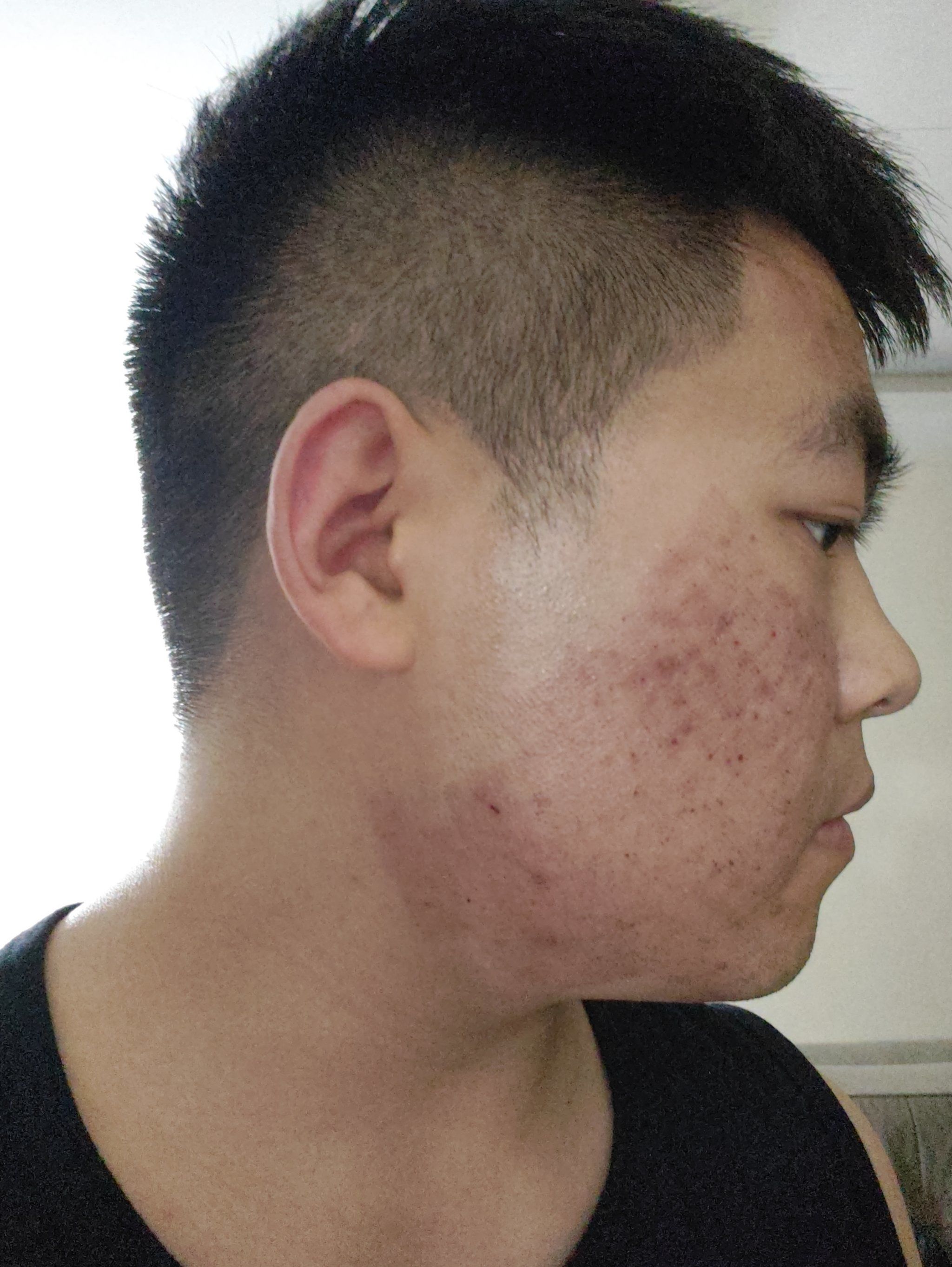 看不下去了还是来治疗一下,上次做了个激光,祛痘印痘坑,觉得效果还