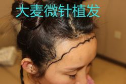 -大麦微针植发丨全国连锁