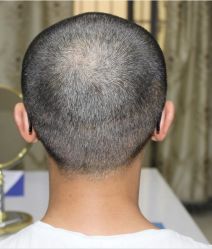 -大麦微针植发全国连锁