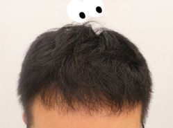 -大麦微针植发全国连锁