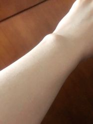 体验后-海涛医疗美容·面部抗衰·注射美鼻