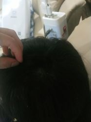 点击看大图 -碧莲盛·不剃发植发