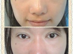 第一天术前术后-上海华安整形外科门诊部