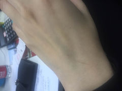 输液留下的针孔-丰茂烤串(金泉美食宫店)