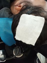 -碧莲盛·不剃发植发