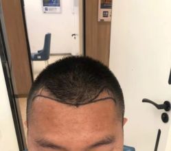 点击看大图 -大麦微针植发丨全国连锁