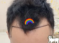 -大麦微针植发全国连锁