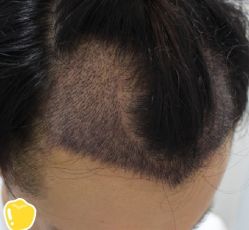 -大麦微针植发丨全国连锁