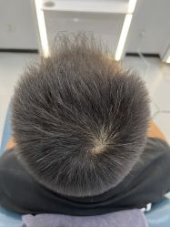 体验后-大麦微针植发全国连锁