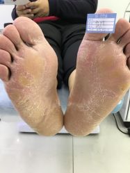 -派恩宜灰指甲鸡眼嵌甲手足癣