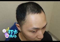 -大麦微针植发全国连锁