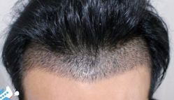 -大麦微针植发丨全国连锁